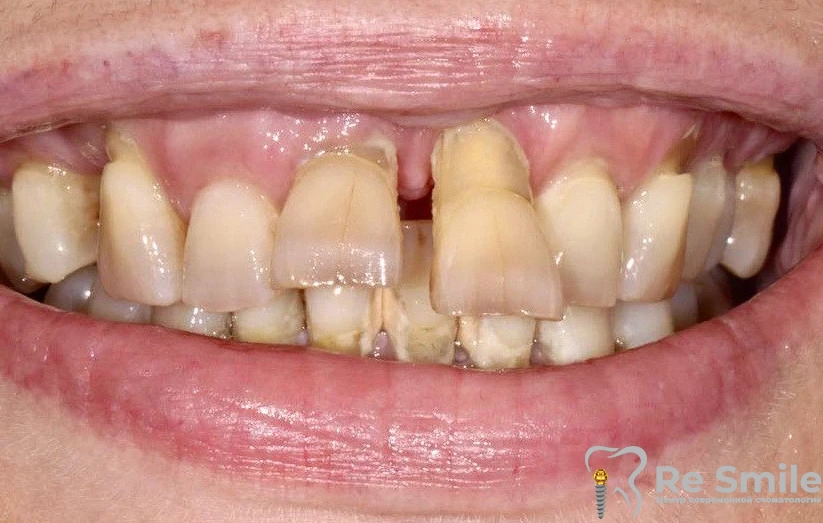 Пациентка обратилась с жалобами на неудовлетворительную эстетику и подвижность зубов на фоне пародонтоза.

Были удалены подвижные зубы и одномоментно установлено по 8 имплантов на обеих челюстях.

На 3-й день установлен адаптационный протез длительного ношения.