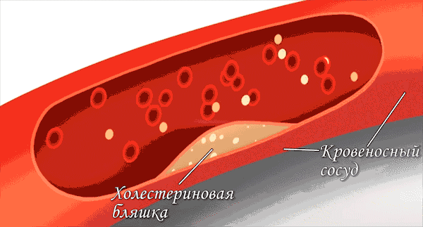 Источник: https://immunocap.ru | В норме тромб должен закупоривать место повреждения на стенке сосуда, после чего кровь останавливается. Но при сильном тромбообразовании происходит закупорка самих сосудов без всяких повреждений – из-за этого отдельные участки организма перестают получать необходимое им питание из кровотока (листайте галерею изображений)