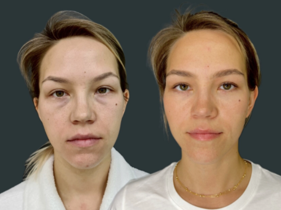 Нижняя блефаропластика / Пластический хирург Владимир Зленко