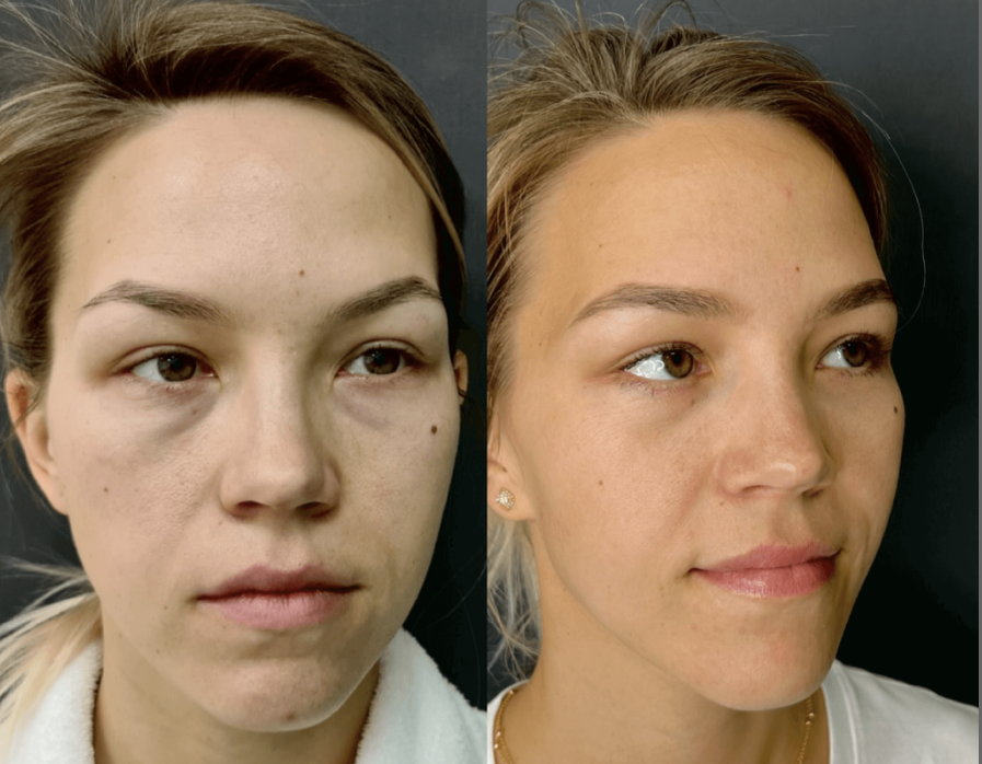 Нижняя блефаропластика / Пластический хирург Владимир Зленко