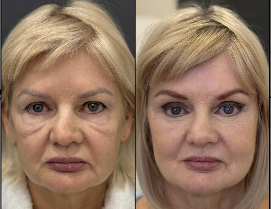 Блефаропластика верхних и нижних век. Эндоскопическая подтяжка верхней и средней трети / Пластический хирург Владимир Зленко