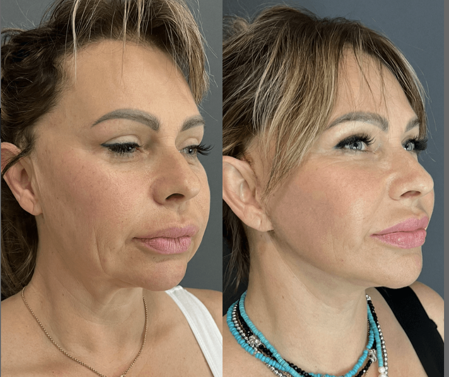 Хирургический SMAS-лифтинг / Пластический хирург Владимир Зленко