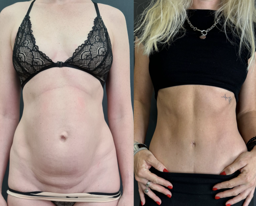 Абдоминопластика / Пластический хирург Владимир Зленко