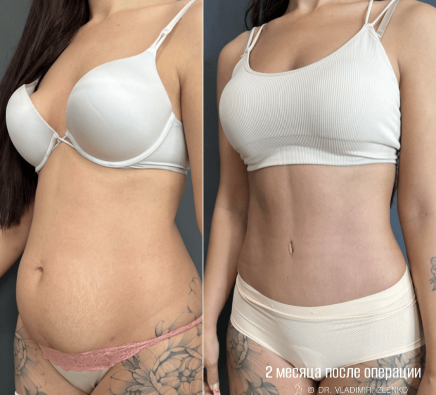 Абдоминопластика / Пластический хирург Владимир Зленко