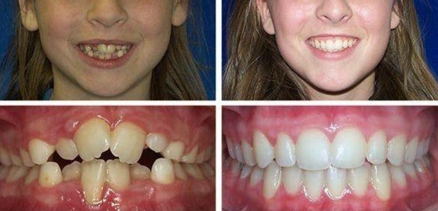 Частично ретинированные зубы изменяют прикус и эстетику👆эффект после лечения брекетами