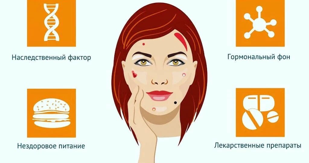 АКНЕ И ЖКТ: правда ли что причина в кишечнике?