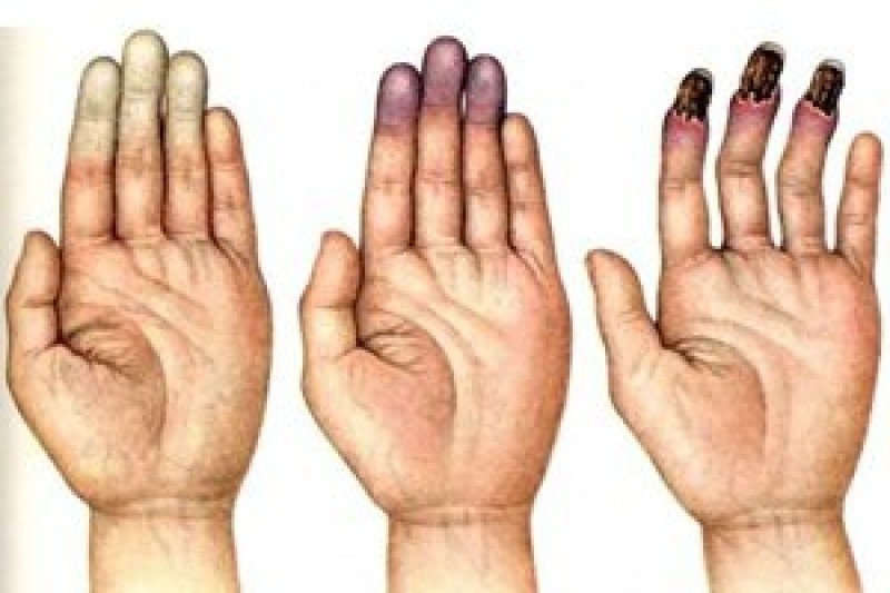 Минус пальцы (Болезнь Рейно)