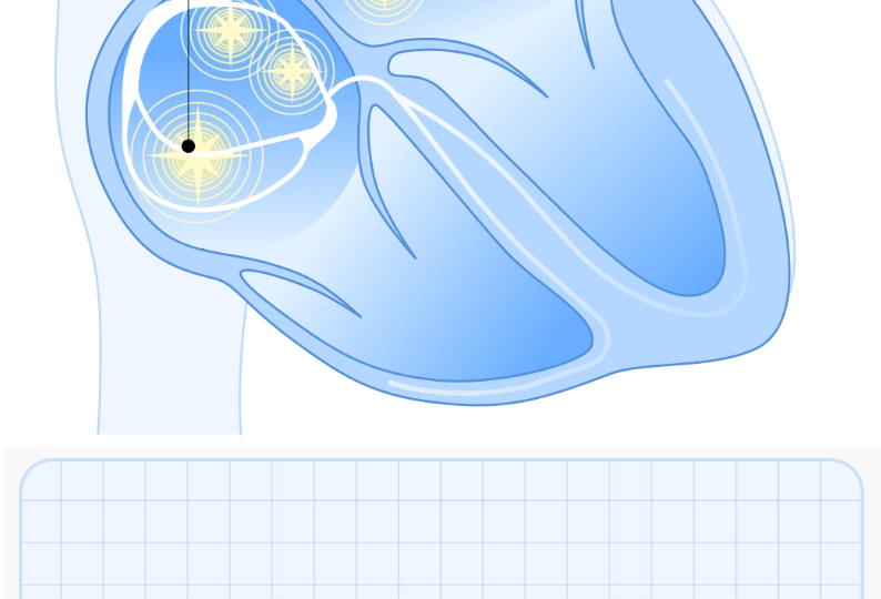 Чувство сердцебиения (Фибрилляция предсердий)