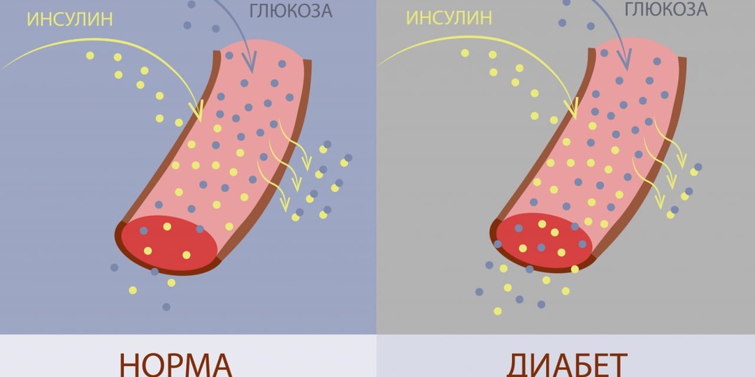 Диабет 2 типа: что делать, если сахар держится 6–7 без лечения