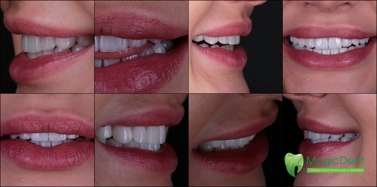 Преображение улыбки у девушки 25-ти лет