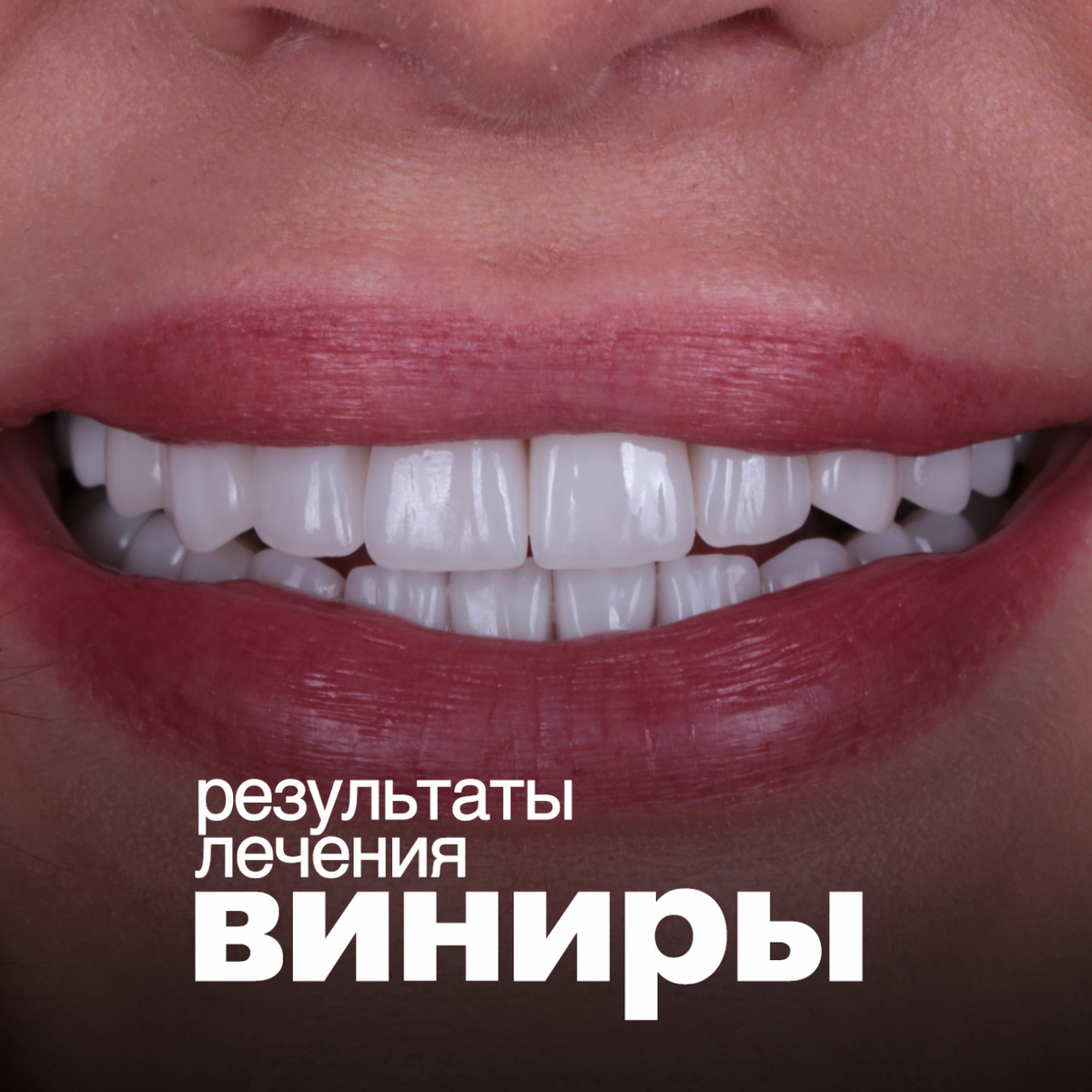 Установка виниров и коронок EMax