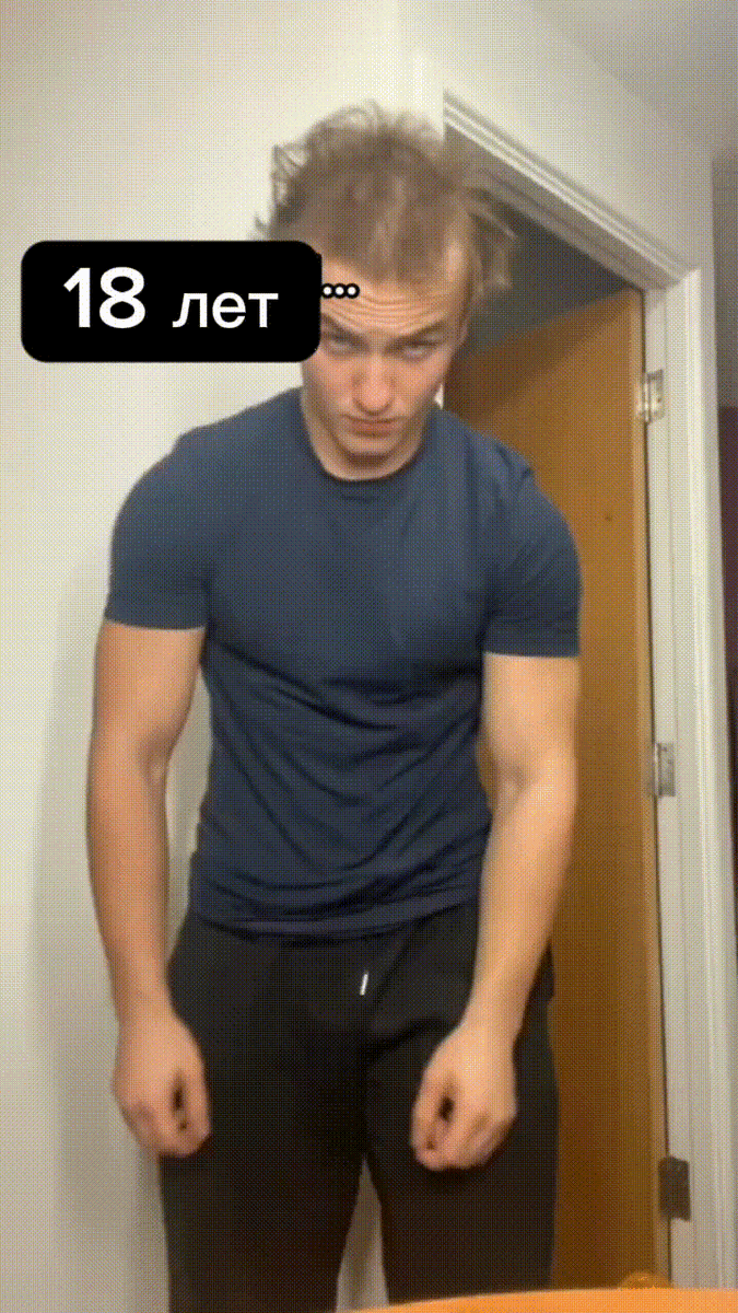 Алопеция молодеет. Автор видео: lukewhillance