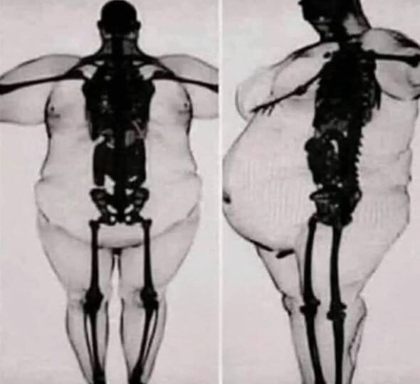 ВЗАИМОСВЯЗЬ МАССЫ ТЕЛА И СОСТОЯНИЕ КОСТЕЙ СКЕЛЕТА