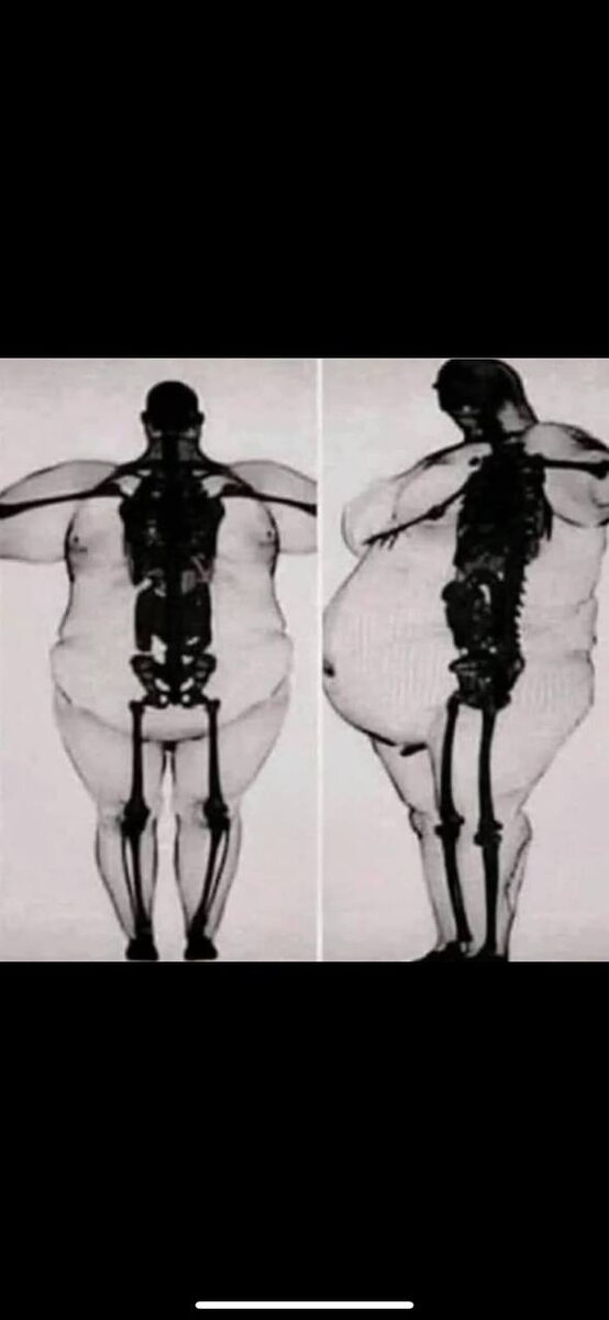 рентген и ожирение