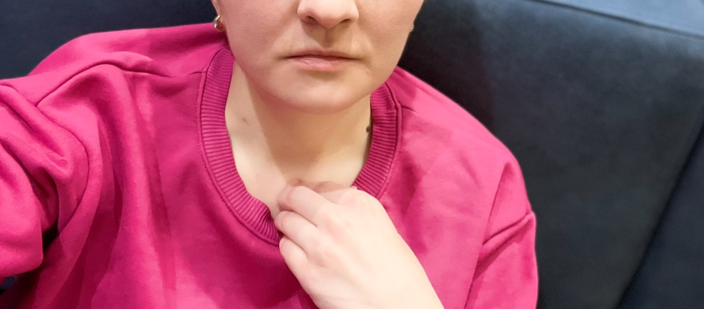 Третий день после операции. Пока без зубов. Вы видите отек? Я не вижу