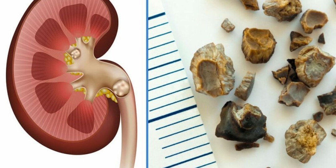 Камни в почках: как избавиться в зрелом возрасте