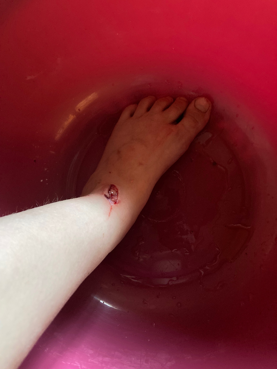 Только только выздоровела и тут бах ударилась об грядку только это было полдня назад щас уже это по-другому выглядит и я не могу стать с места запретили мне поэтому видео не будет