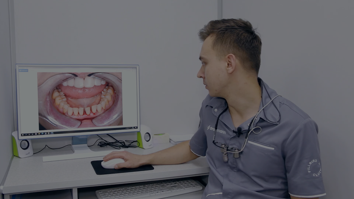 Генерализованный парадонтит