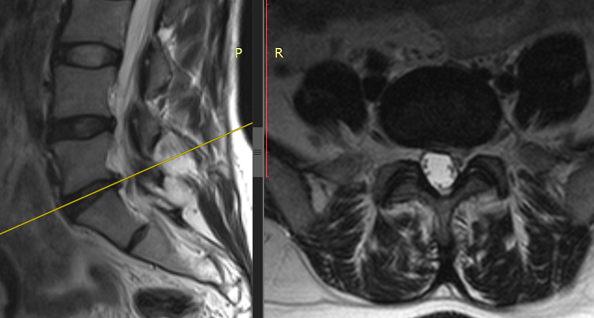 Грыжа стала причиной боли и онемения в ногах. Снимок ДО операции
