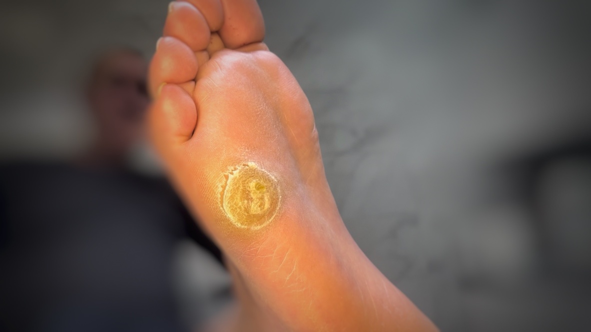 Размер мозольной массы 