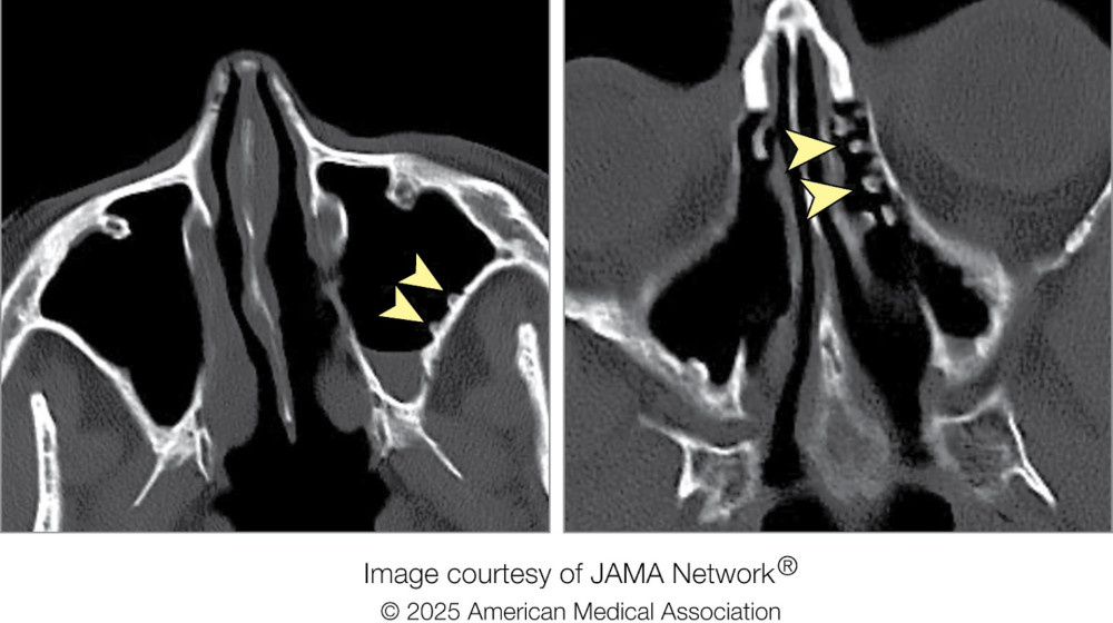   Холодные промывания носа превратили пазухи женщины в "булыжную мостовую"