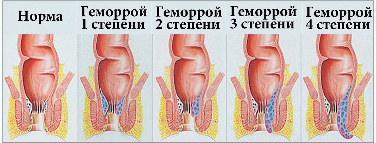 Стадии геморроя
