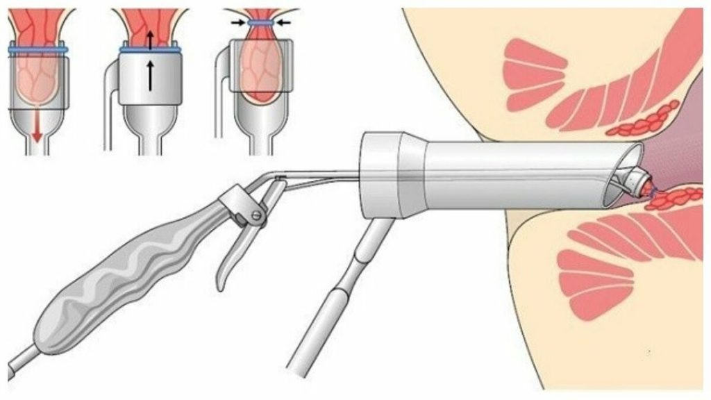 Вакуумное лигирование геморроидального узла