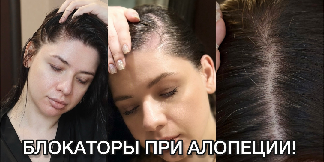 БЛОКАТОРЫ ПРИ АЛОПЕЦИИ. ВЫПАДЕНИЕ ВОЛОС. ОТ ЧЕГО ВЫПАДАЮТ ВОЛОСЫ? АГА. ВИБРОЗ. ДИФФУЗНОЕ ВЫПАДЕНИЕ ВОЛОС