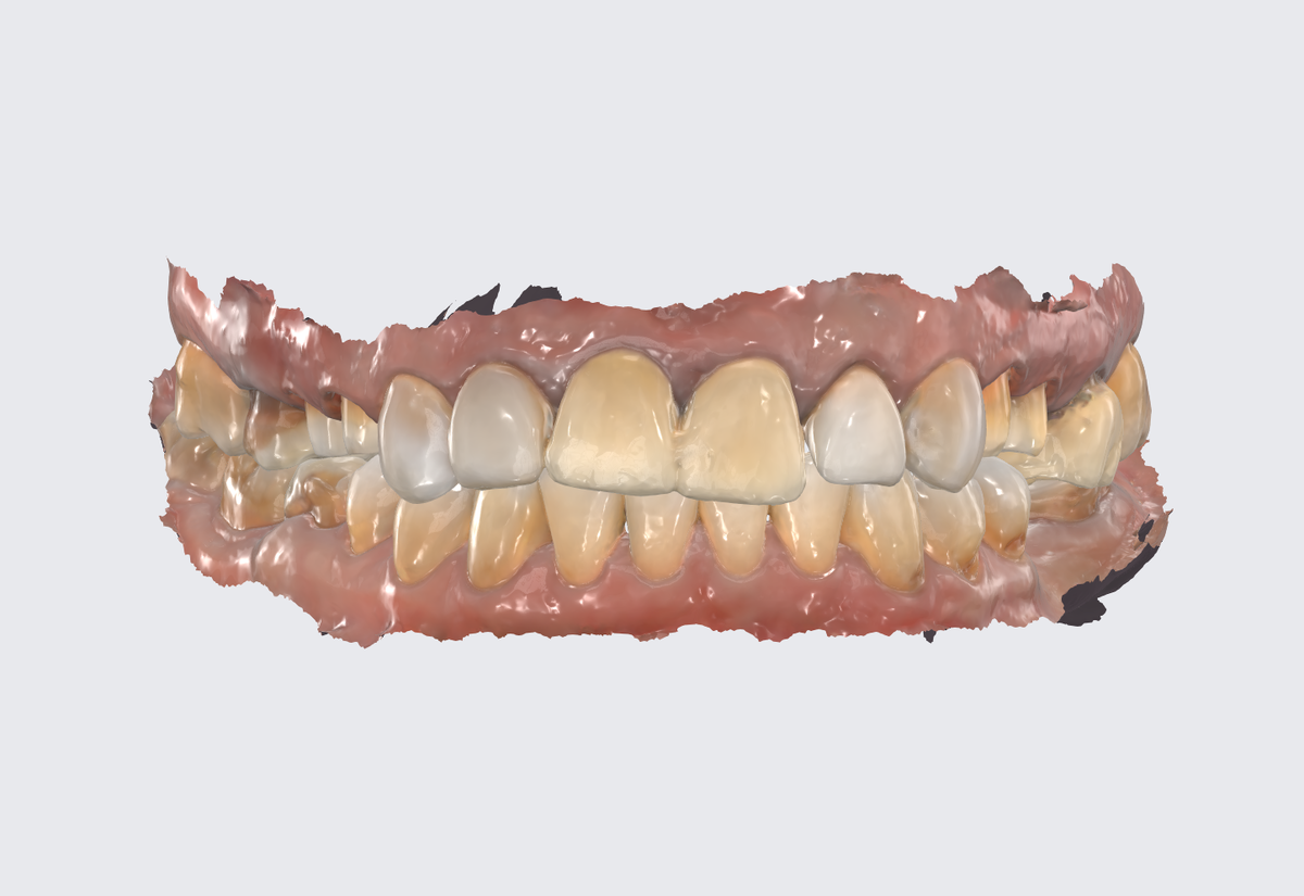 Сканирование 3Д, цифровой слепок