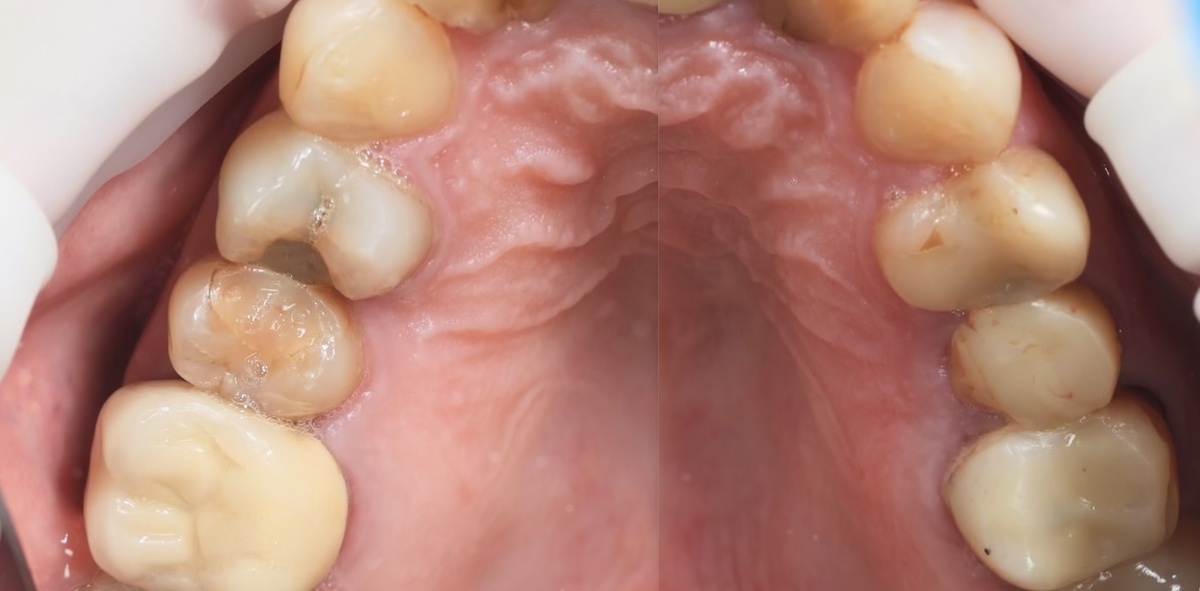 Ситуация с премолярами ДО лечения