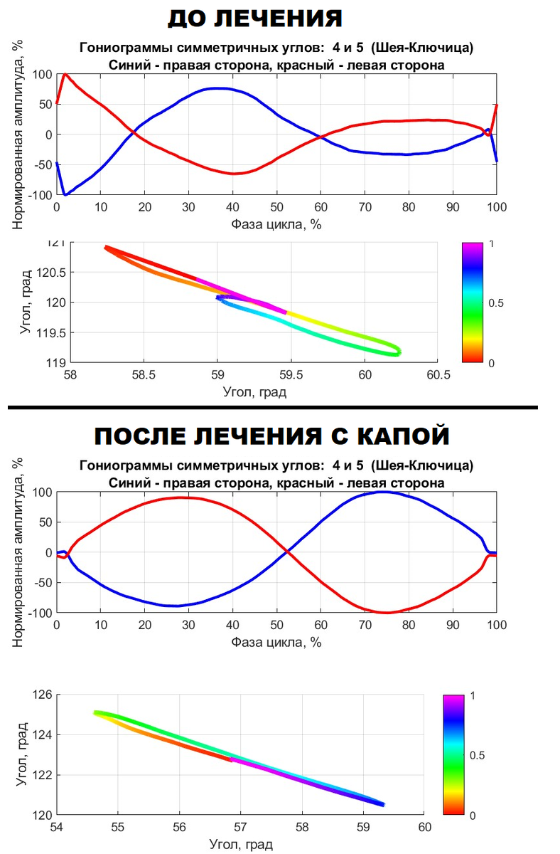 Гониограммы до и после подбора капы. Движение: бег на месте (циклическое движения). Видно, что после подбора капы движения плечевого пояса стали более симметричными (красная и синяя линяя стали похожими). Все данные дополнительно доступны в формате Excel: каждый цикл характеризуется 500 точками.
