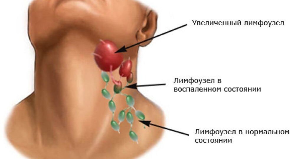 Что происходит, когда рак распространяется на лимфатические узлы?