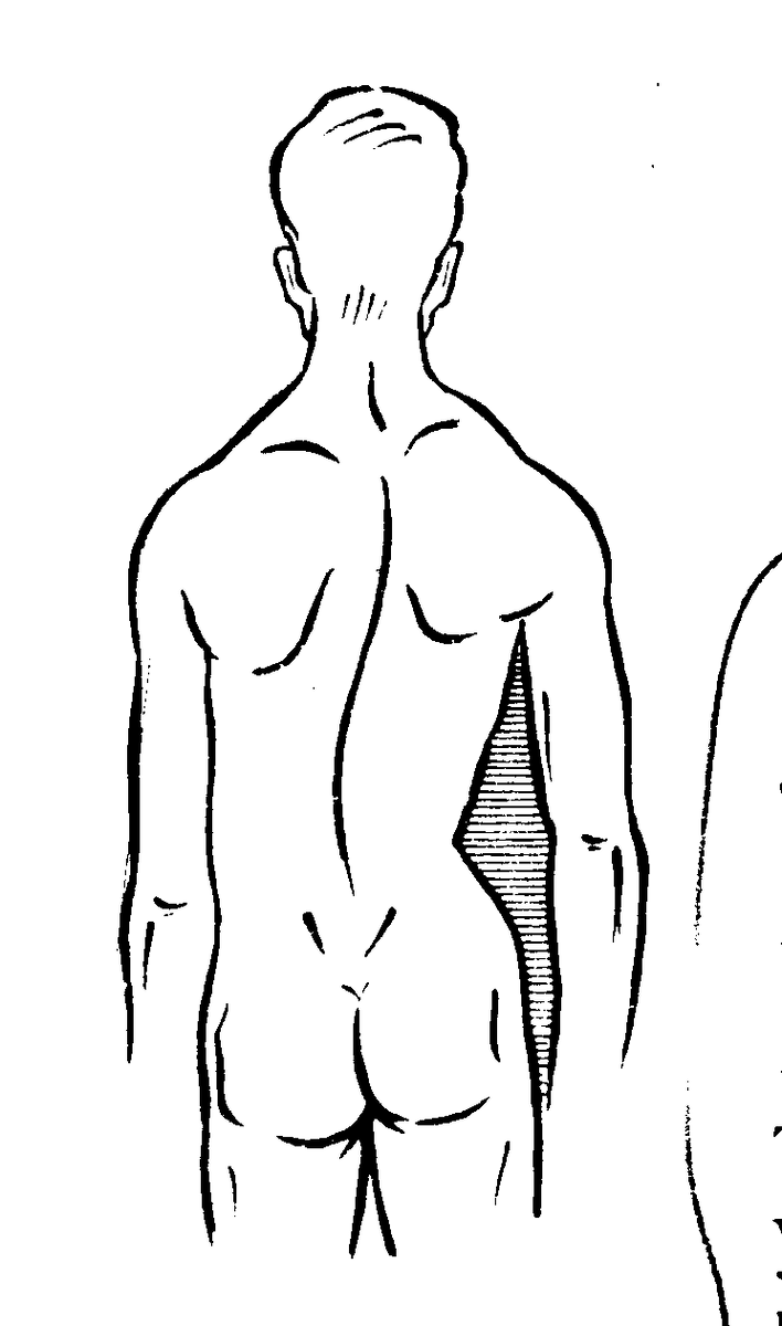 Ассимптрию можно заметить по тому что треугольники талии будут не равны, с одной стороны треугольник может и вовсе отсутствовать