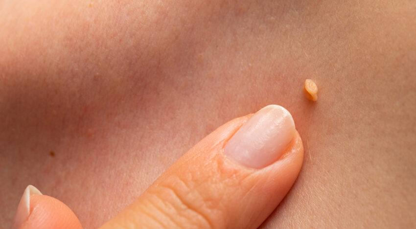 Папиллома на шее