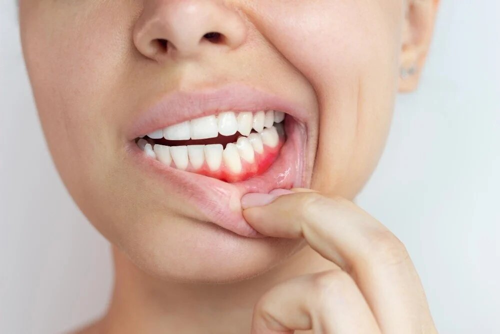 Когда десны кричат "SOS": почему нельзя игнорировать кровоточивость и воспаление