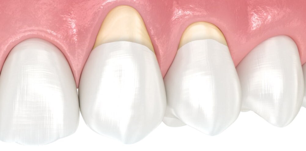 Почему зубы «ломаются» у десны и как это остановить?