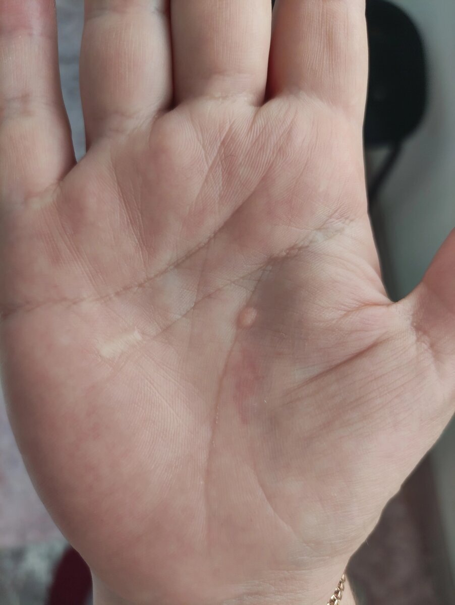 Фото руки с бородавкой в прошлом. Фото с моего канала. 