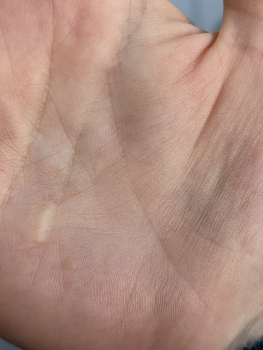 Фото с моего канала. Сейчас бородавки уже нет, она исчезла. 