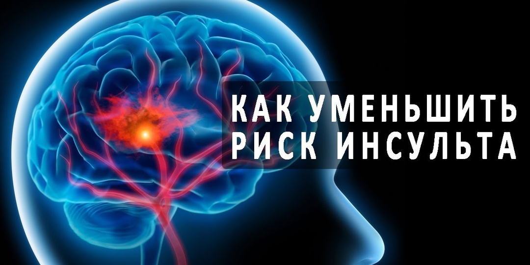 Инсульт без давления: как распознать опасность и спасти жизнь