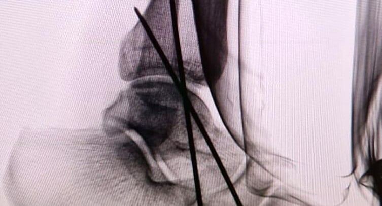    рентген голеностопного сустава после установки спиц / пресс-служба Долгопрудненской больницы