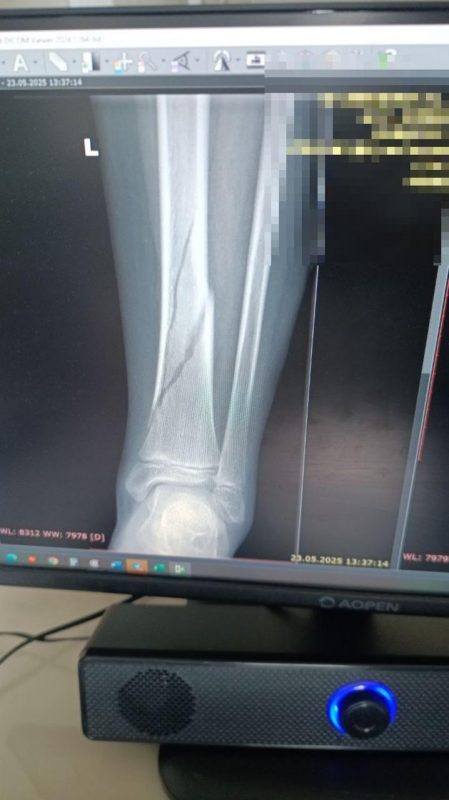    Без медицинского образования понятно - перелом тяжелый