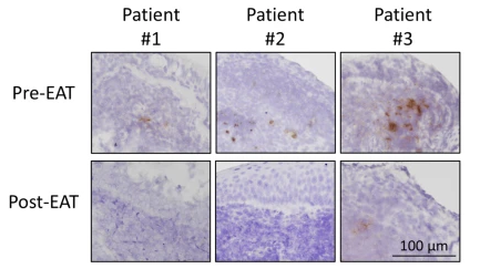 Оценка эпифарингеальной абразивной терапии (EAT) на макроскопическое эпифарингеальное воспаление и экспрессию вирусной мРНК у пациентов с длительным COVID