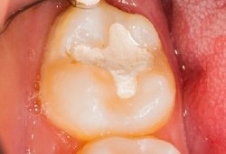 Цементная пломба