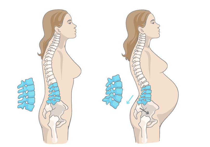 Гиперлордоз