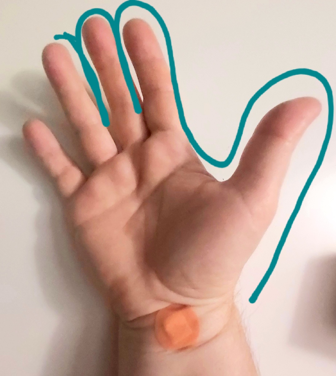 Вот он, тоннельничек, сегодня сделали очередной укол, как нужно