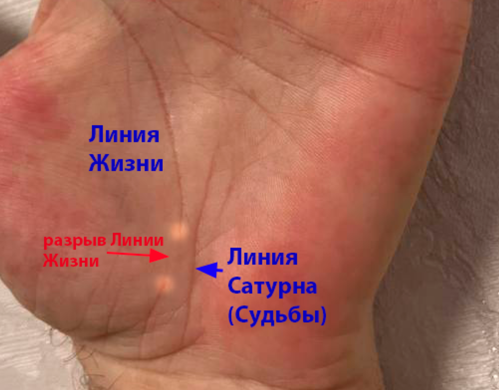 Разрыв Линии Жизни. Линия Сатурна компенсирует Линию Жизни.