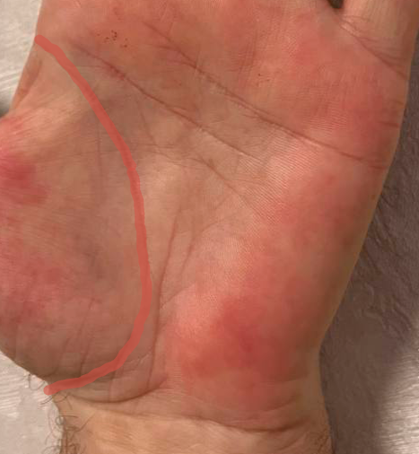 Коррекция Линии Жизни