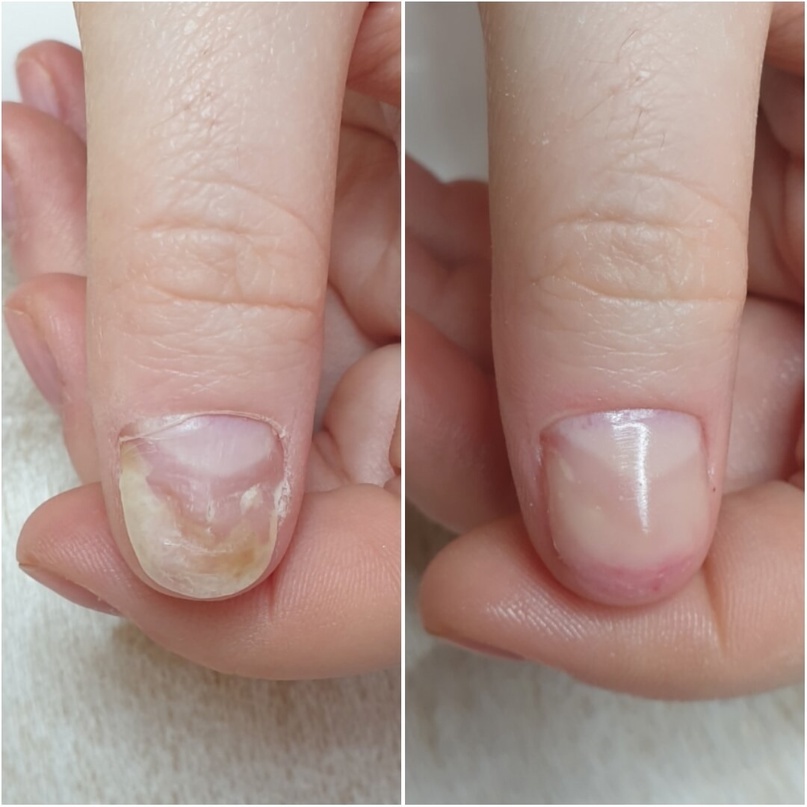 До и после протезирования ногтя