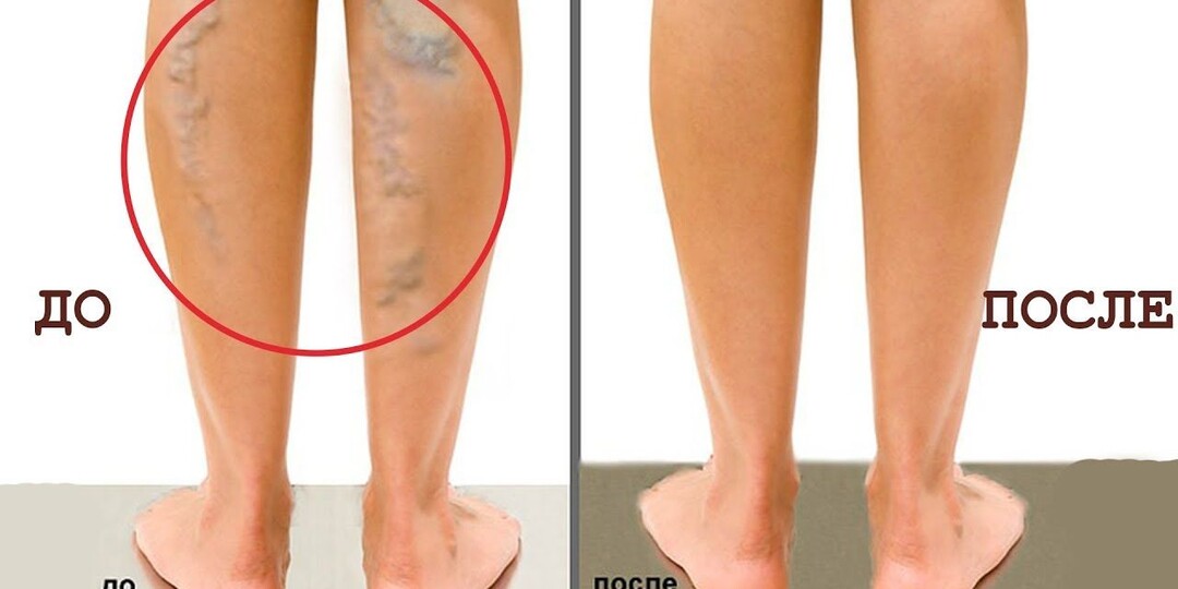 Вены на ногах: почему операция — это не выход