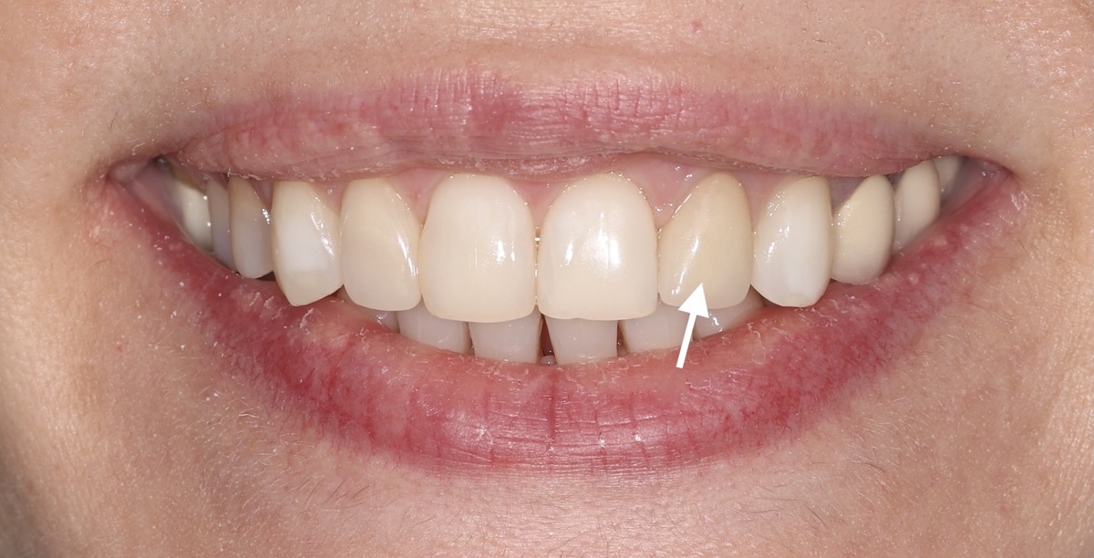 Зуб 2.2 просит коронку - он депульпирован и под большой пломбой находится, которая может сломаться